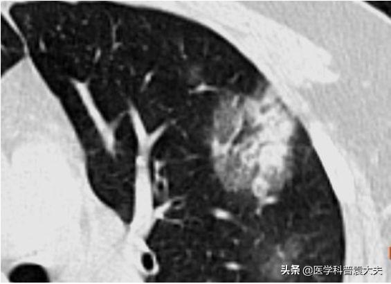 全面视角与观点阐述,肺炎最新了解