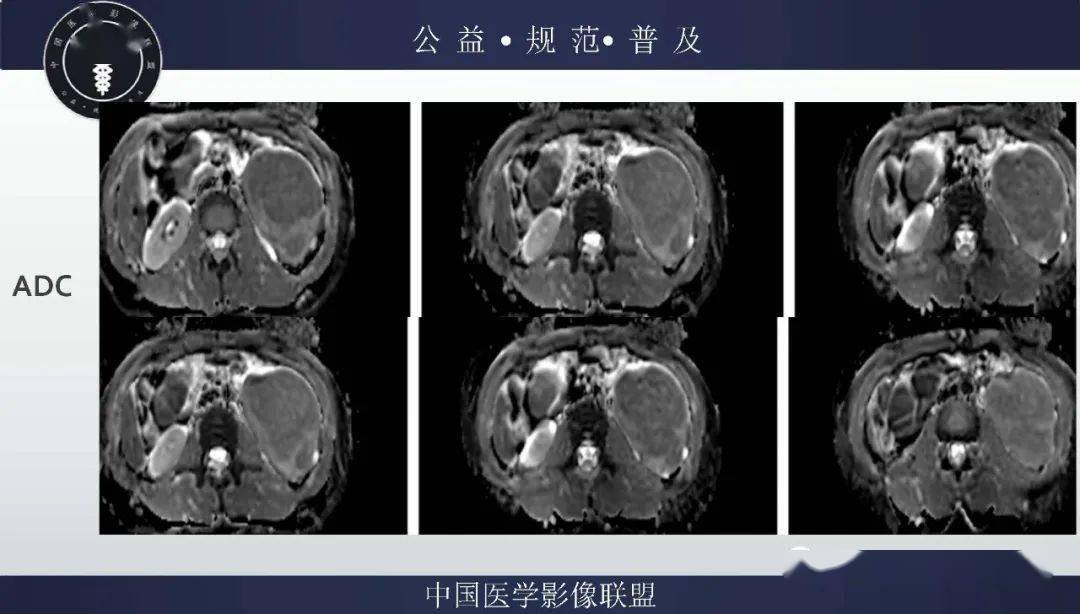 腹膜间皮瘤最新治疗进展，探索自然美景的心灵之旅与医学进步的力量