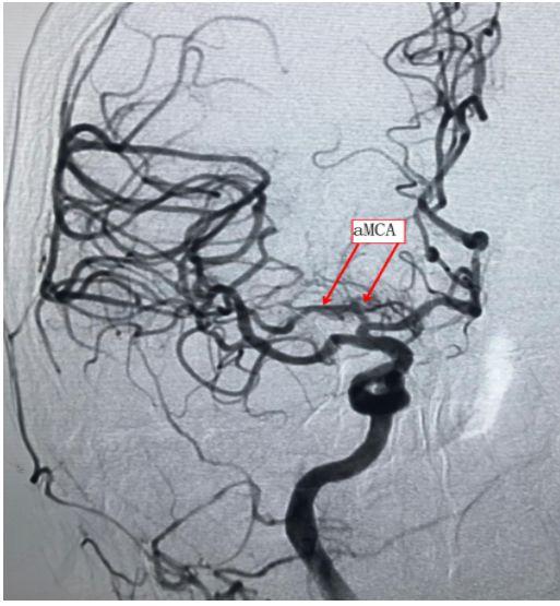 神经纤维瘤最新资讯更新🌟